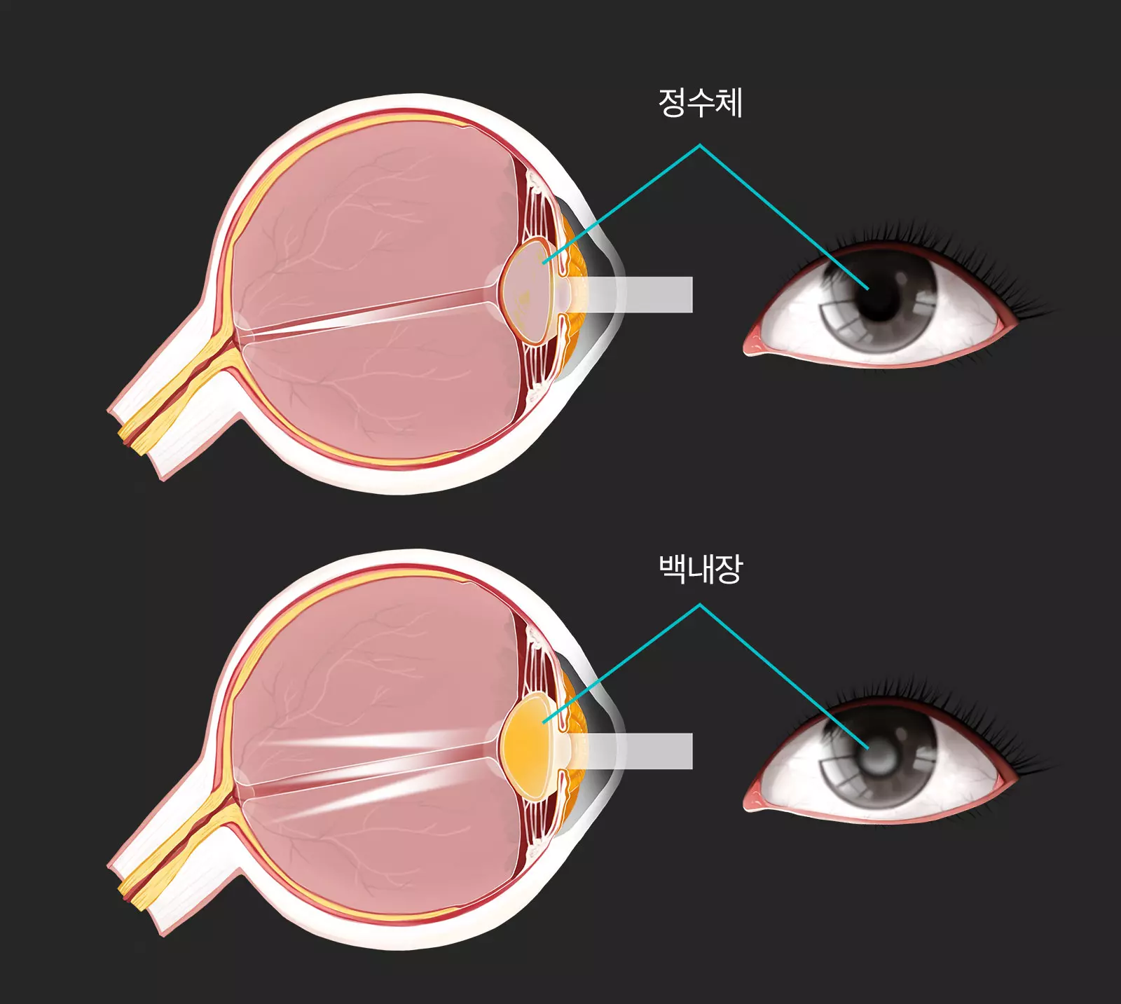백내장 (Cataracts)
