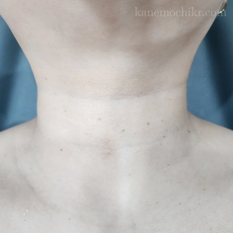 쥐젖-편평사마귀