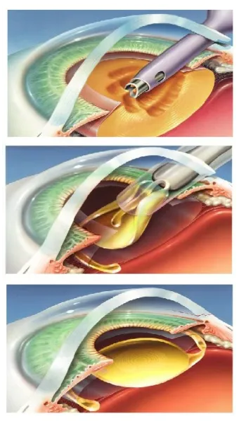 백내장 수술 비용 실비 보험 청구 회복기간_19