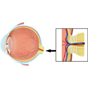 시신경염과 시신경척수염의 원인과 증상, 안구통증과 시신경손상