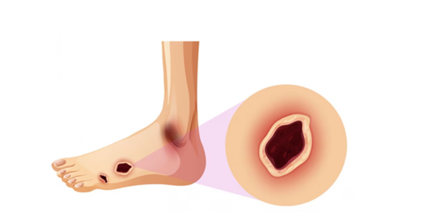 당뇨발(diabetic foot) 사진