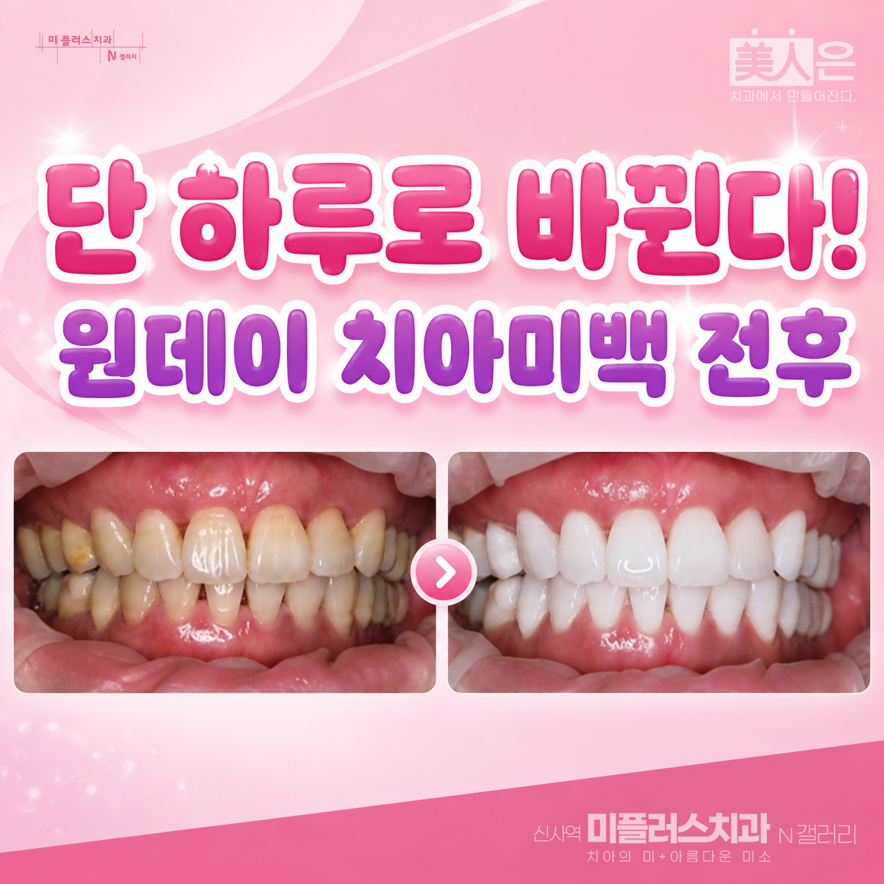 원데이 치아미백 전후 비교 사진으로 치아 색상 변화를 확인할 수 있는 사례