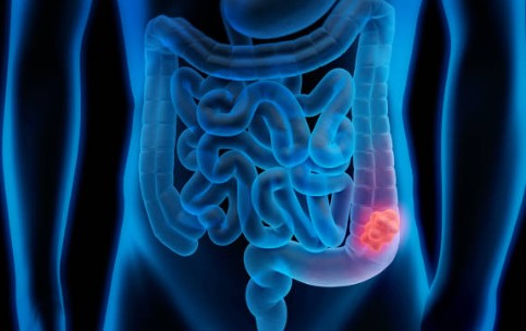 대장내시경 전 음식 초기증상