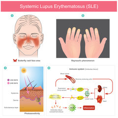 루프스 병 (systemic lupus erythematosus)&amp;#44; 전신성 홍반성 원인과 증상에 대해 알아봤습니다. 매우 생소한 이름인데요. 얼굴에 나비 모양으로 발진이 일어났다면 한번쯤은 의심해봐야 합니다. 루프스 병은 어디 병원으로 가야 하는지와 치료방법까지 천천히 읽어 보시기 바랍니다. 