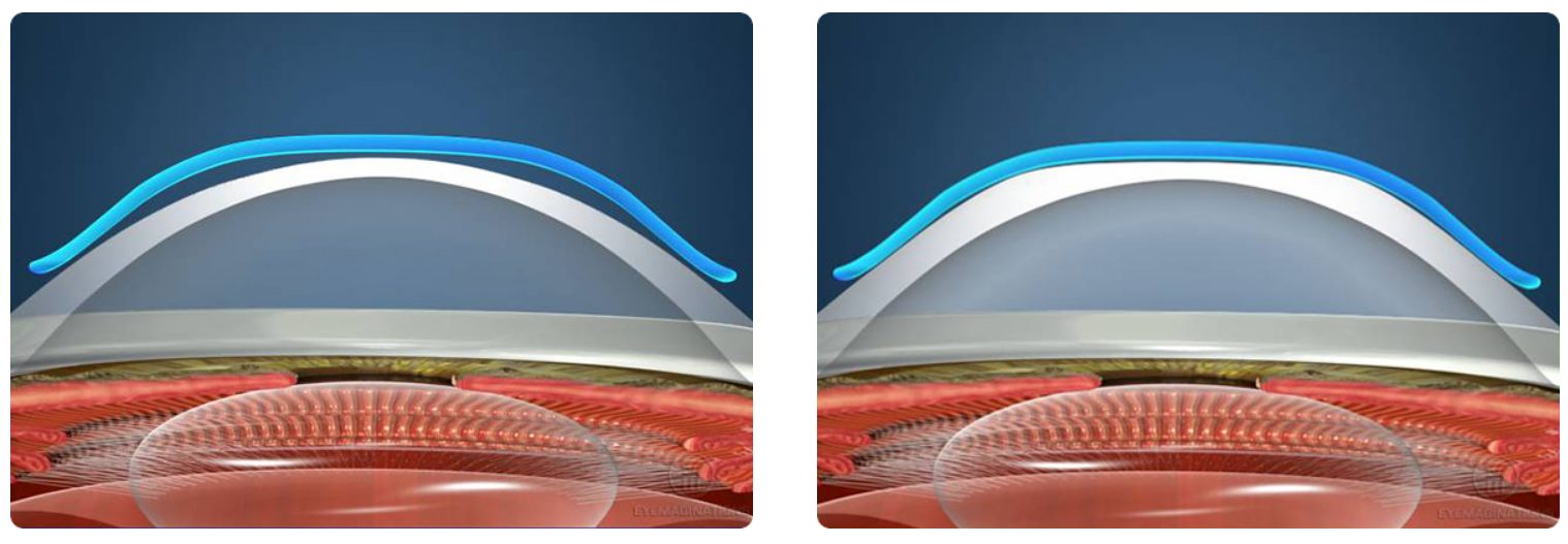 각막 모양 변형을 통한 근시 교정