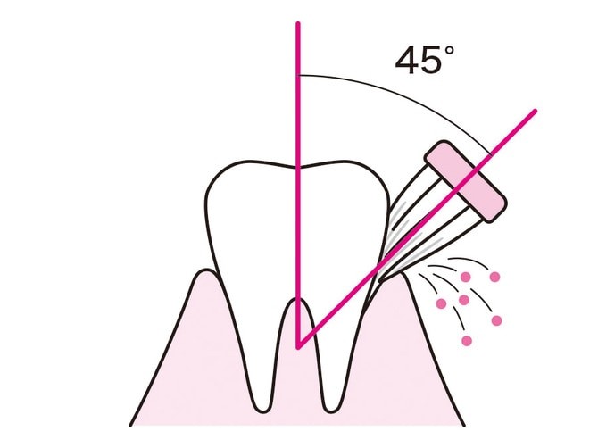 잇몸주머니 (잇몸낭) 닦기