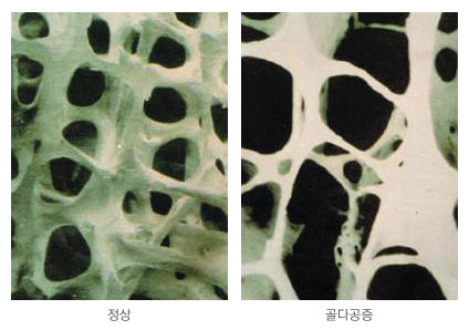 골다공증 원인·증상·치료
