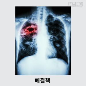 기침이 오래가는 이유