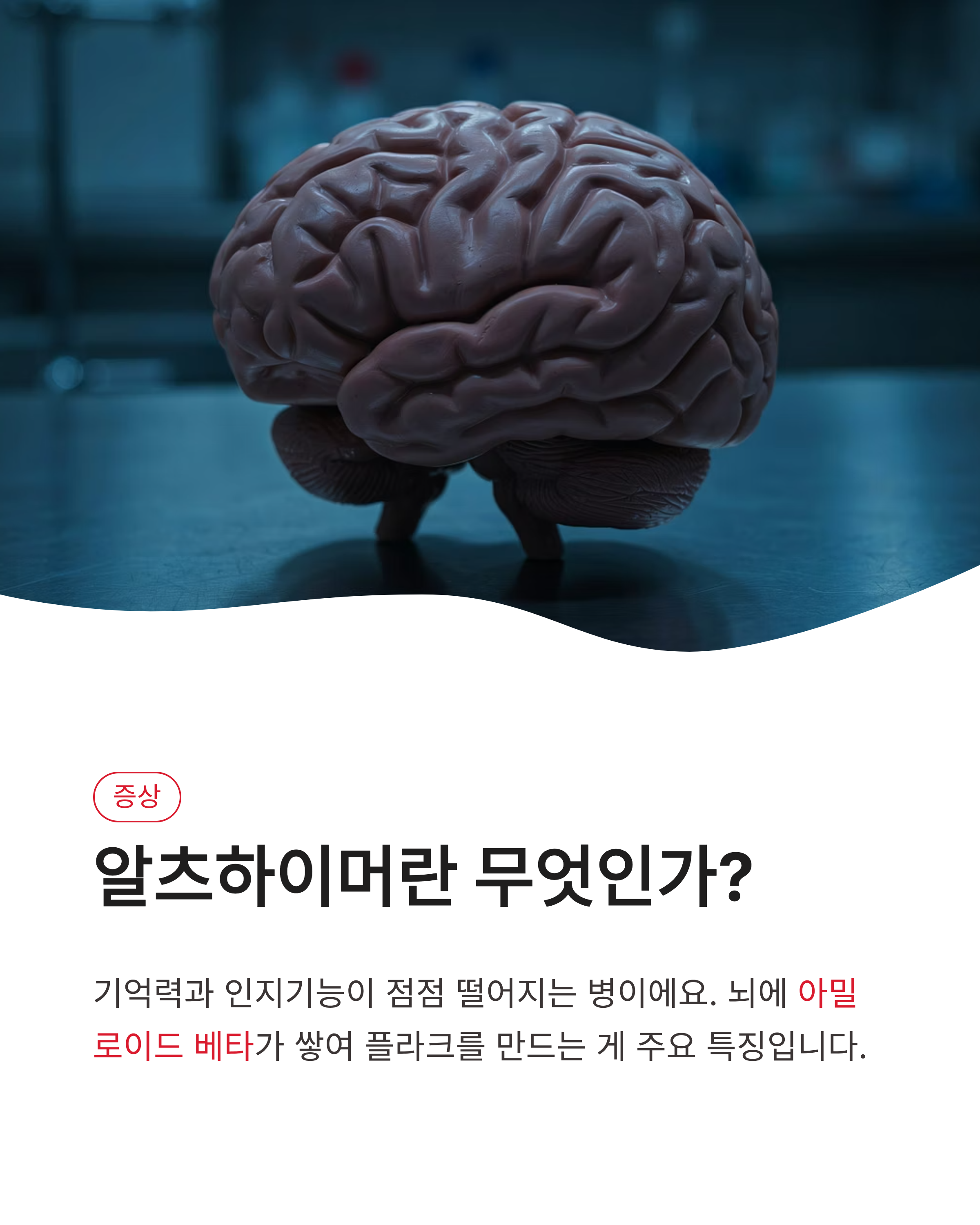 알츠하이머원인 치료제 증상완벽정리!국내 연구진이밝힌 새로운 희망