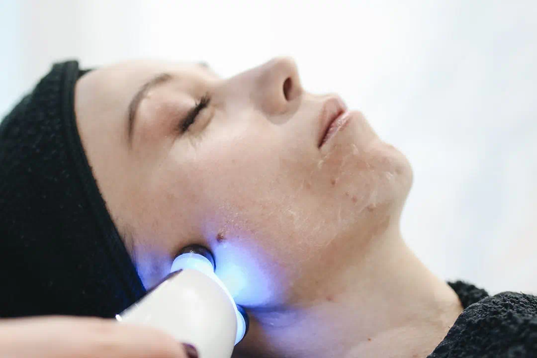 레이저 치료를 받고있는 기미있는 여성3