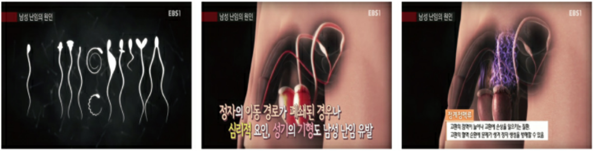 남성난임의 원인