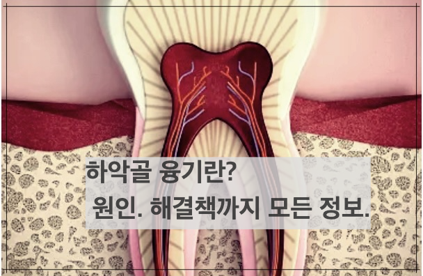 하악골 융기란? 원인. 해결책까지 모든 정보.