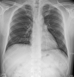 흉부 X-ray에서 자주 나오는 소견 해석하기: &lsquo;이상 소견&rsquo;이라는 말에 당황하지 않는 법