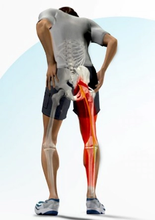 이상근 증후군 원인