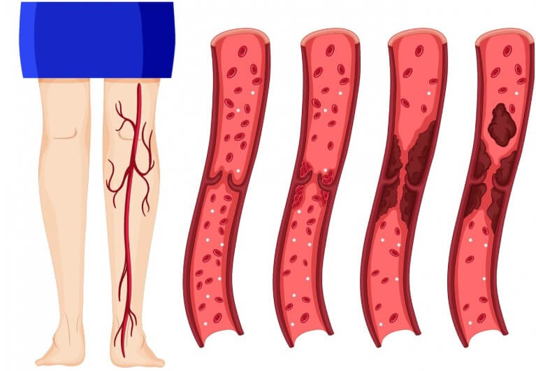 혈관 속 노폐물의 정도