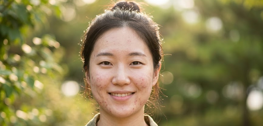 오래된 여드름 흉터, 지금 치료해도 늦지 않았을까?