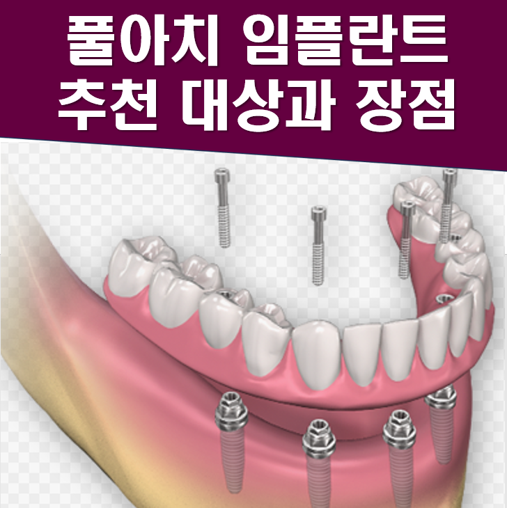 풀아치 임플란트