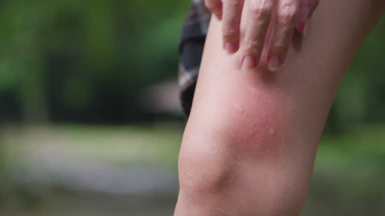 모기 물린곳 물집이 생기는 이유