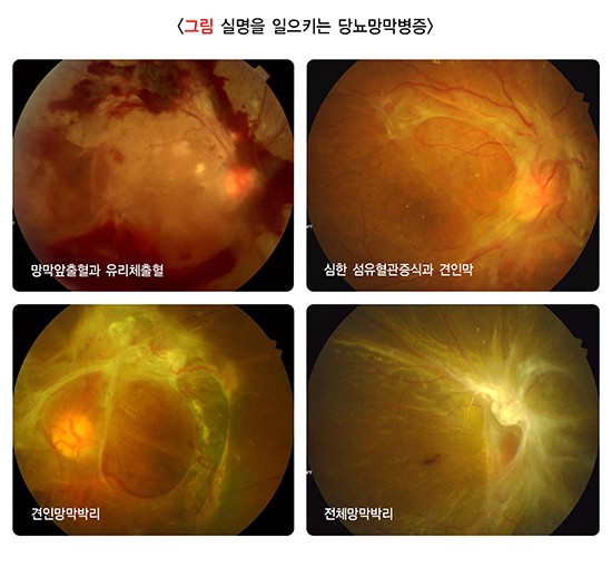 당뇨망막병증