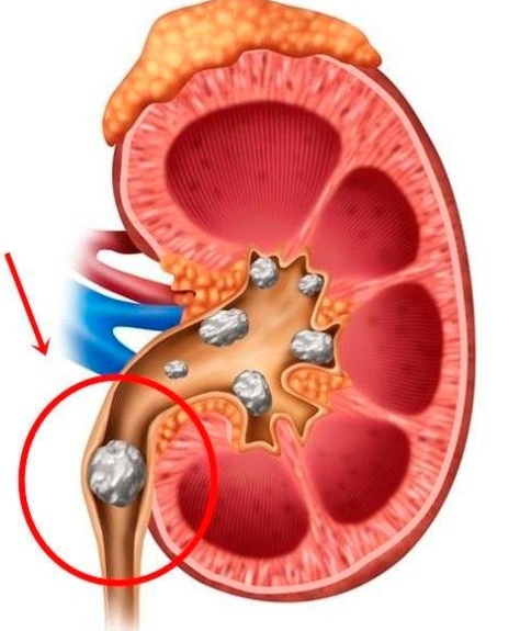 요로결석은 갑작스러운 옆구리 통증과 혈뇨, 배뇨 곤란을 유발하는 질환입니다.