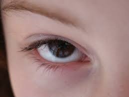 눈 실핏줄이 터지는 이유