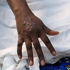 원숭이두창 엠폭스 관련주 대장주 테마주 TOP7