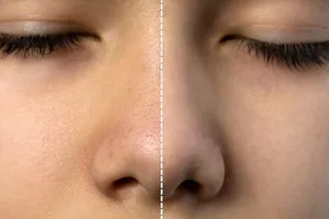 블랙-헤드-제거-방법