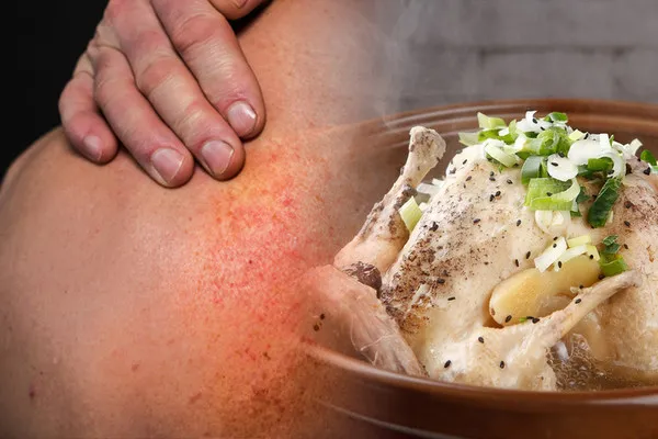 옻닭 효능 먹으면 안되는 사람 닭백숙_2