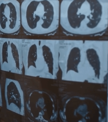 폐결핵 초기증상&amp;#44; 진단 치료 및 주의할점