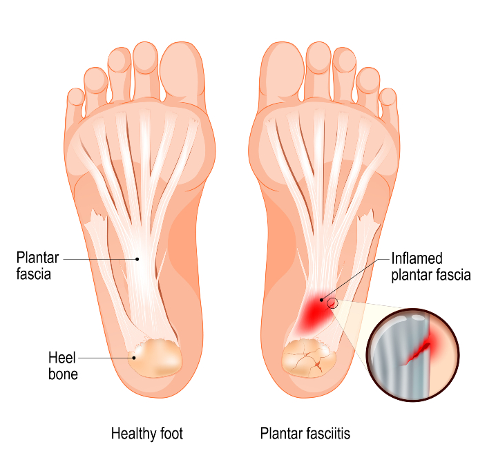족저 근막염 치료