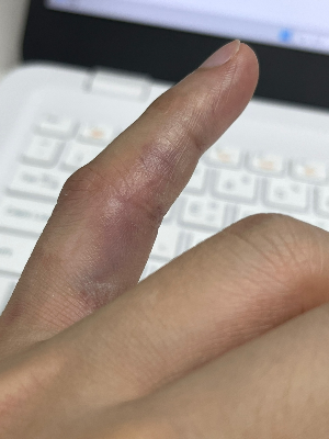 다친손가락-멍든손가락