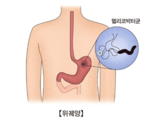헬리코박터 제균 치료로 고령층 위암 예방 효과 관련 이미지