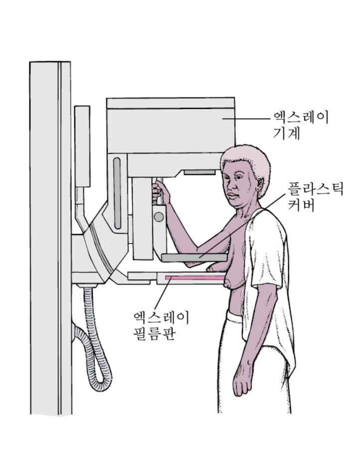 유방 조영술 : 유방암 선별검사