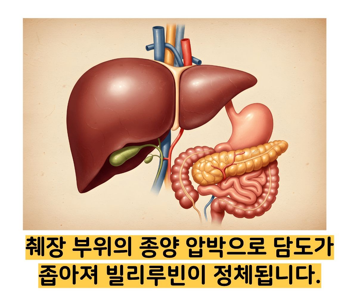 빌리루빈 수치상승 원인