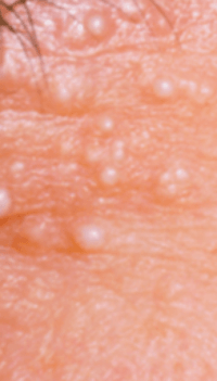 눈밑에 하얀 좁쌀