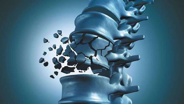 골다공증 초기증상 전단계 전조증상 7가지