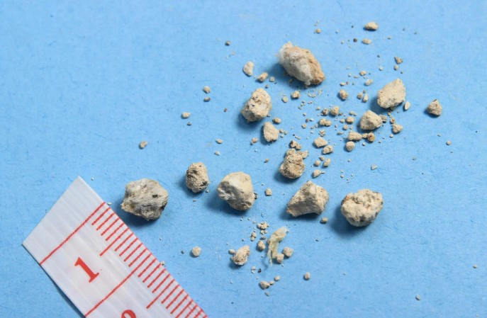 체외충격파쇄석술 과정 