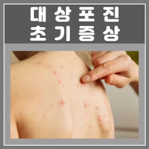 대상포진 초기증상 원인 치료 예방