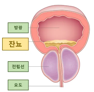 잔뇨량 개선