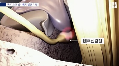 방사통