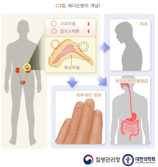 부신피질 호르몬제의 부작용