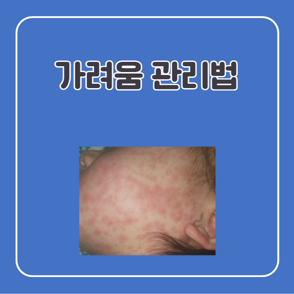 열꽃 두드러기 가려움 관리법