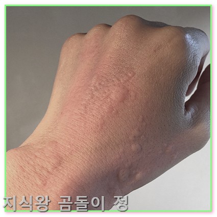 손등 좁쌀 두드러기 피부장벽 회복과 보습 꿀팁5