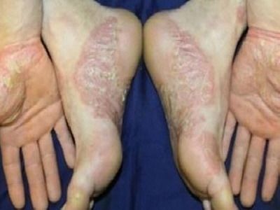 건선 초기 증상