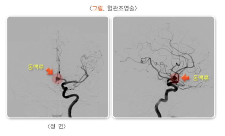 혈관조영술