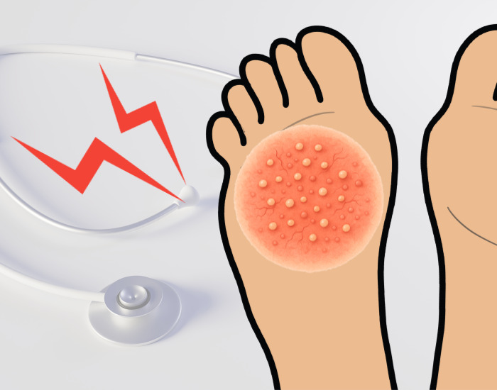 심하게 수포가 올라온 발바닥