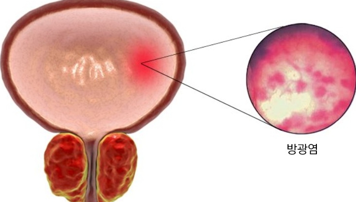 방광염 / 요로감염
