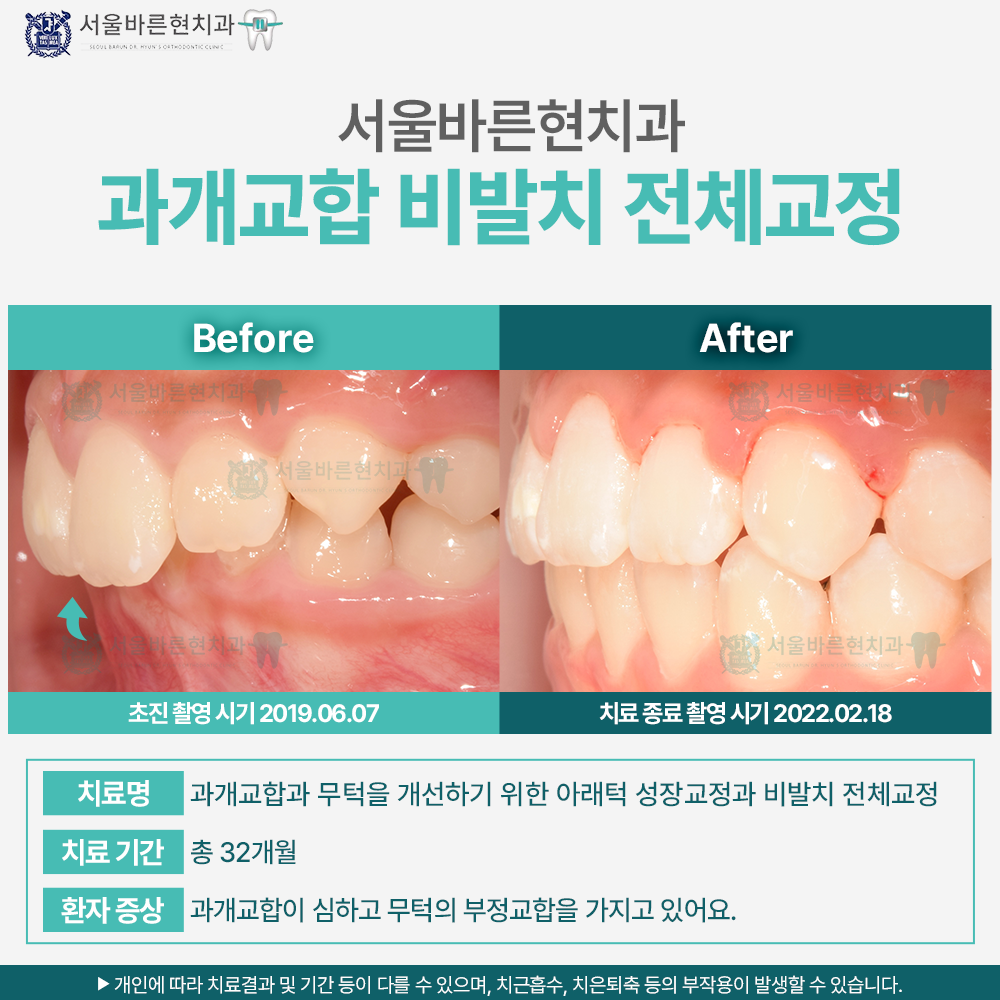해운대치아교정