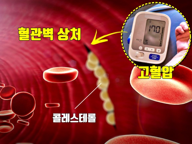혈압이 높을때 증상, 고혈압 증상, 혈관벽 상처