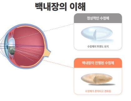 백내장 증상